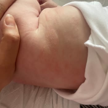 Bebeğimin Cildinde Şampuan Nedeniyle Egzama Oluştu, 712 TL İade Talep Ediyorum