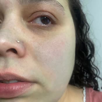 Bee Beauty Maske Cildimi Yeşile Çevirdi: Şok Edici Tahriş Ve Renk Değişikliği