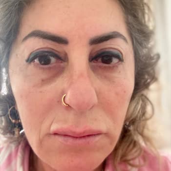 Sözleşme Ve Fatura Verilmemesi, Ayıplı Hizmet Ve Yüzde Çizgi Oluşması Nedeniyle İade Talebi