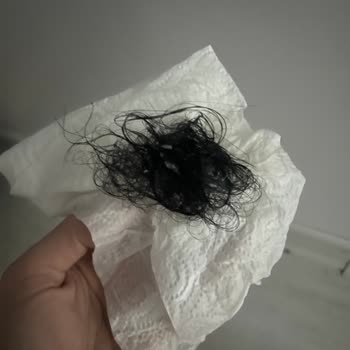 San Kuaför Salon Saç Bakımı Sonrası Şiddetli Saç Dökülmesi Ve İade Talebi