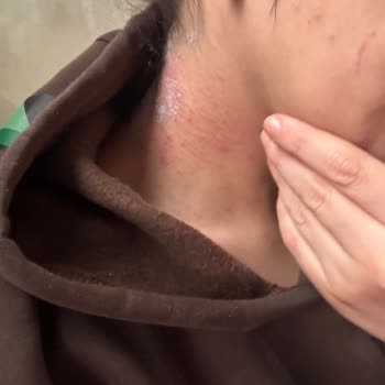 Organik Saç Boyasında Şiddetli Alerjik Reaksiyon