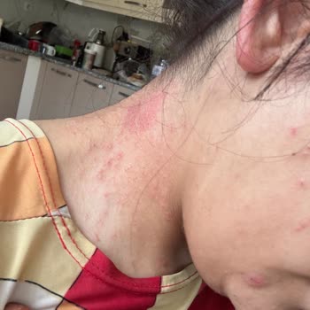 Organik Saç Boyasında Şiddetli Alerjik Reaksiyon