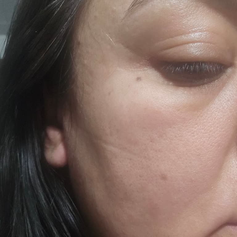 Yves Rocher Ürünlerinde Şiddetli Alerjik Reaksiyon Ve İade Talebi