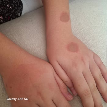 Çocuğumda Alerjik Reaksiyon: Watsons Deodorantı Ve Şirketin Düşük İlgisi