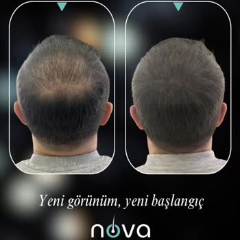 Vaat Edilen Ağrısız Saç Simülasyonu Gerçekleşmedi Ve Fotoğraflar İzinsiz Paylaşıldı