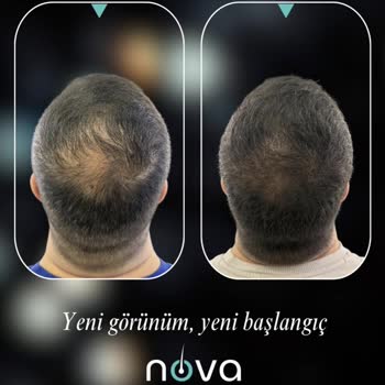 Vaat Edilen Ağrısız Saç Simülasyonu Gerçekleşmedi Ve Fotoğraflar İzinsiz Paylaşıldı