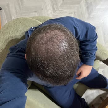 Vaat Edilen Ağrısız Saç Simülasyonu Gerçekleşmedi Ve Fotoğraflar İzinsiz Paylaşıldı