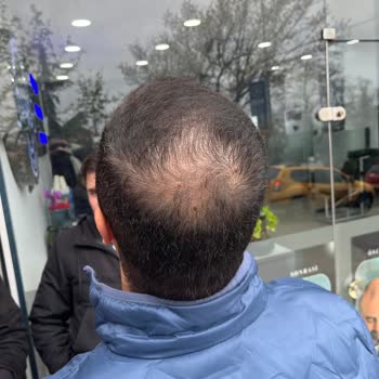 Vaat Edilen Ağrısız Saç Simülasyonu Gerçekleşmedi Ve Fotoğraflar İzinsiz Paylaşıldı