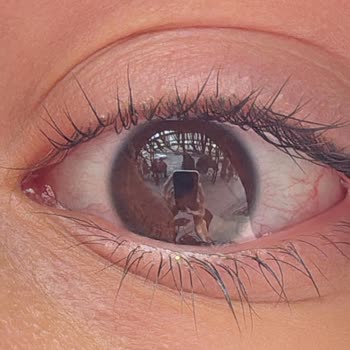 Koruyucu Gözlük Kullanılmadan Lazer Epilasyonda Göz Yanığı Ve Güvenlik İhlali