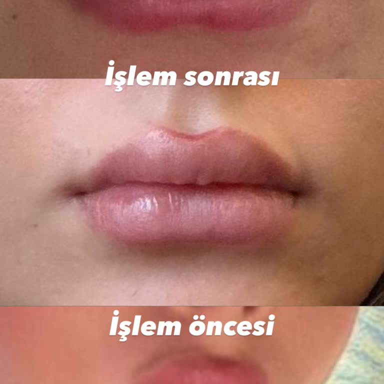 Mehrzad Clinic | @m_technique.poya Dudaklarıma Ne Enjekte Edildi Bilmek İstiyorum