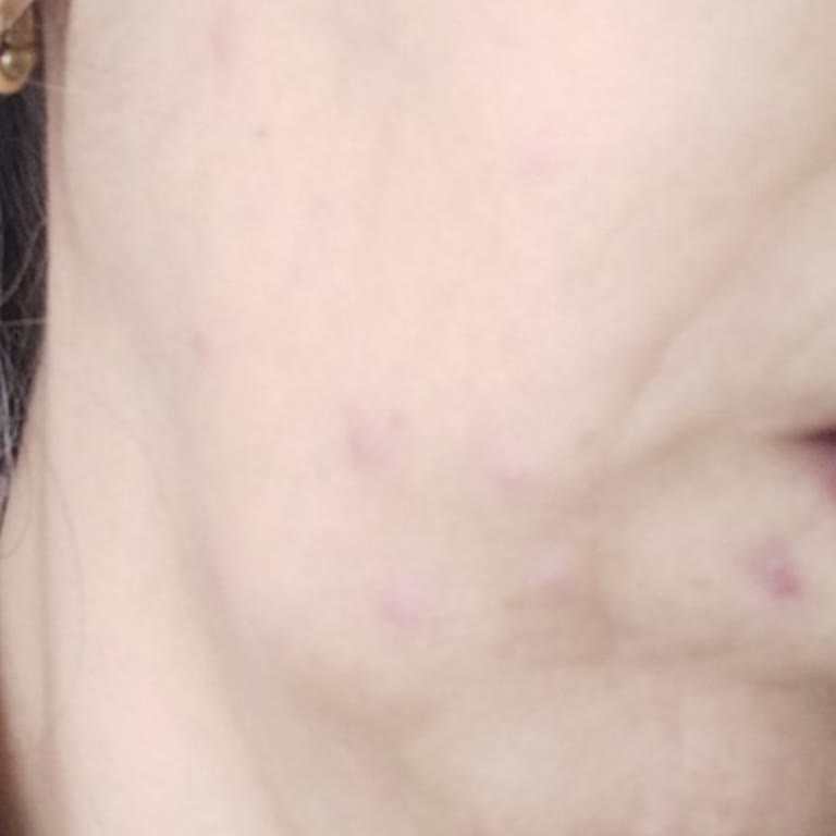 Watsons Duoderm Nemlendiricide Alerjik Reaksiyon Ve İade Talebi