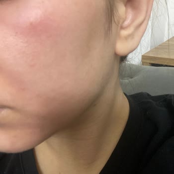 Clinoper Jel Kullanımından Şiddetli Yanma Ve Yüz Şişliği