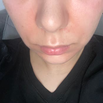 Clinoper Jel Kullanımından Şiddetli Yanma Ve Yüz Şişliği