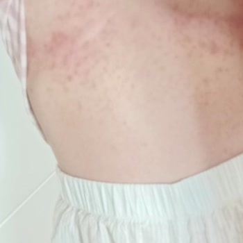 Dove Duş Köpüğünün Alerjik Reaksiyonu Nedeniyle Sağlık Sorunu Ve İade Talebi