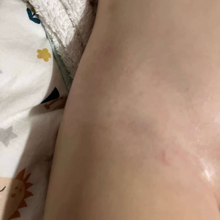 Molfix’in Yeni Formülü Çocuğumun Cildinde Şiddetli Tahrişe Yol Açtı