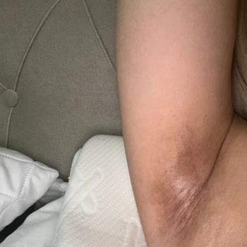 İsana Deo-Creme Kullanımından Sonra Koltuk Altı Kararması Ve Ücret İadesi Talebi