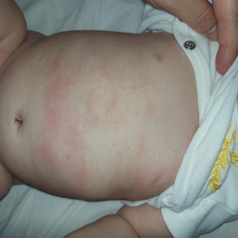 Mustela Nemlendirici Bebekte Şiddetli Döküntü Ve İade Talebi