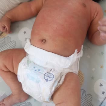 Bebekte Şiddetli Yanma Ve Kızarıklık Yaratan Mustela Stelatopia Ürünü