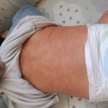 Bebekte Şiddetli Yanma Ve Kızarıklık Yaratan Mustela Stelatopia Ürünü