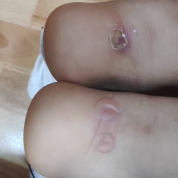 Kısa Sürede Yırtılan Ve Ayak Yarası Açan Reebok Ayakkabı İçin İade Talebi