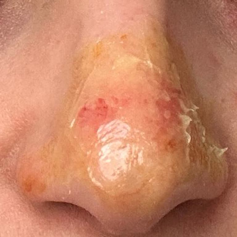 Burun Bandı Cildi Şiddetle Tahriş Etti