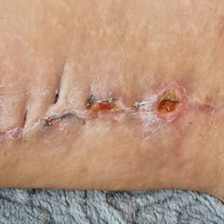 Ameliyat Sonrası Estetik Sonuçların Başarısızlığı Ve Kan Parası İadesi Talebi