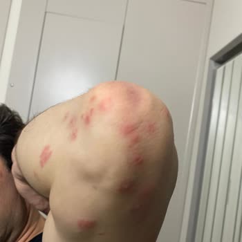 Sağlık Riski Tahtakurusu Ve Hijyen Sorunu Oda Değiştirmeyle Çözülmedi