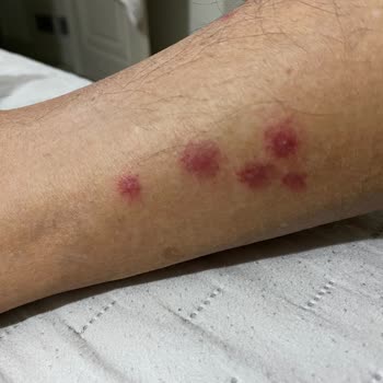 Sağlık Riski Tahtakurusu Ve Hijyen Sorunu Oda Değiştirmeyle Çözülmedi