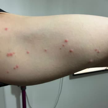 Sağlık Riski Tahtakurusu Ve Hijyen Sorunu Oda Değiştirmeyle Çözülmedi