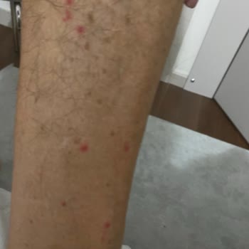 Sağlık Riski Tahtakurusu Ve Hijyen Sorunu Oda Değiştirmeyle Çözülmedi