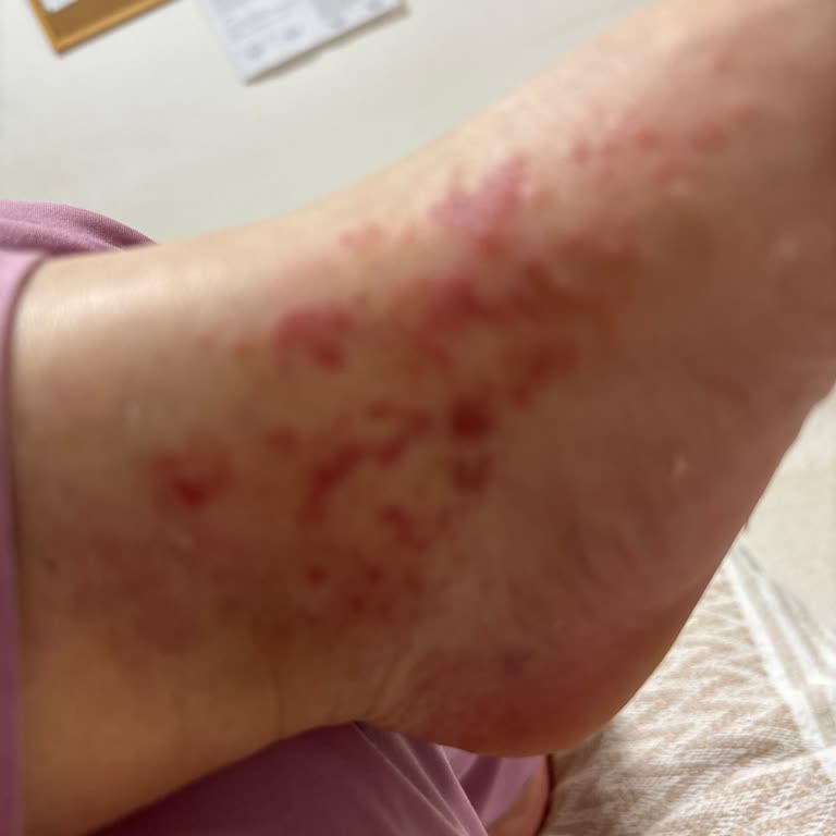 Gratis Ayak Maskesi Sonrası Cilt Hasarı Ve Sağlık Endişesi