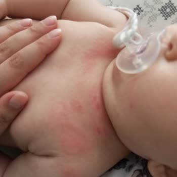 Johnson’s Baby Bebek Yağının Tek Kullanımda Şiddetli Döküntü Ve Kızarıklığa Sebep Olması