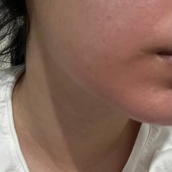 Missha Ve All Around Güneş Kremlerinde Hassas Ciltlerde Şiddetli Reaksiyon Ve İade Talebi