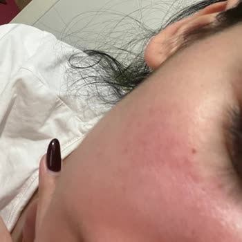 Missha Ve All Around Güneş Kremlerinde Hassas Ciltlerde Şiddetli Reaksiyon Ve İade Talebi