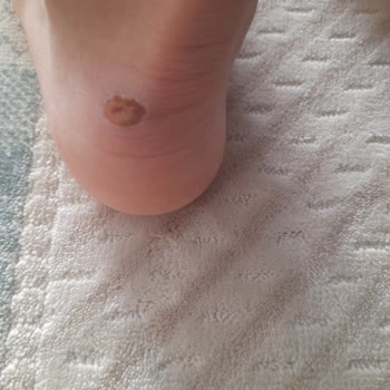 Adidas Handball Spezial Ayakkabısı Topukta Şiddetli Yara Oluşturdu, Değişim Talep Ediyorum