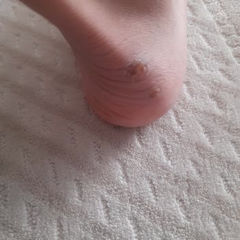 Adidas Handball Spezial Ayakkabısı Topukta Şiddetli Yara Oluşturdu, Değişim Talep Ediyorum