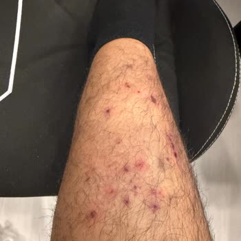Free-Sub Dalış Elbisesinde Alerjik Reaksiyon Ve Satıcıdan Çözümsüz Yanıt