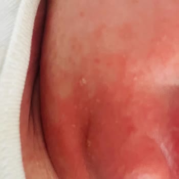 Bebekte Alerjik Reaksiyon Ve Yüksek Ücret Şikayeti