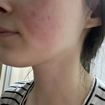 Yves Rocher Yüz Yıkama Jelinde Yanma Ve Kızarıklık İade Talebi