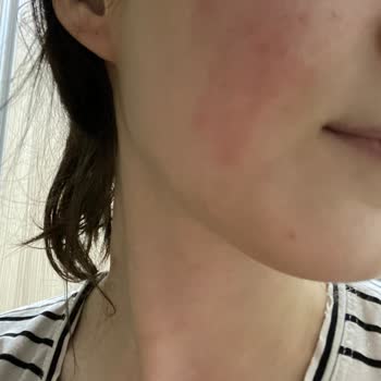 Yves Rocher Yüz Yıkama Jelinde Yanma Ve Kızarıklık İade Talebi