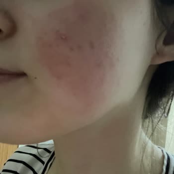 Yves Rocher Yüz Yıkama Jelinde Yanma Ve Kızarıklık İade Talebi