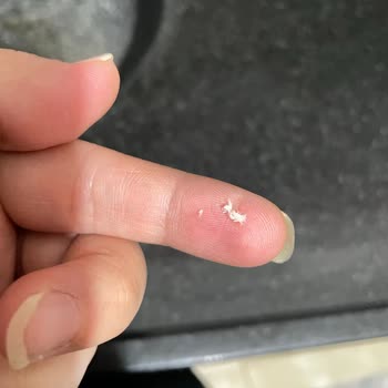 Böğürtlen Aromalı Sakızda Yabancı Parça Tespiti, Hijyen Endişesi Ve Tazminat Talebi