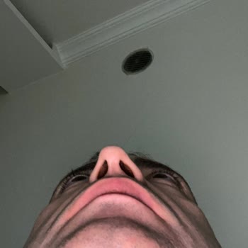 Op. Dr. Halit Baykan Çapraz Burun, Kemer Oluşumu ve Sol Taraf Nefes Darlığıyla Burun Estetiği Kabusu