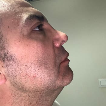 Op. Dr. Halit Baykan Çapraz Burun, Kemer Oluşumu ve Sol Taraf Nefes Darlığıyla Burun Estetiği Kabusu