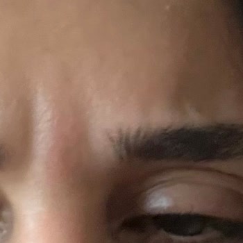 Estemire Kliniğinde Botoks Ve Yüz Germe Sonrası Göz Kapağı Düşmesi Ve İade Talebi