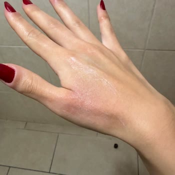 Peros Amberli Yumuşatıcısına Alerjik Reaksiyon Ve Uyarı Eksikliği