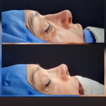 Acıbadem Hastanesinde Başarısız Burun Ameliyatı Ve 110 Bin TL İade Talebi