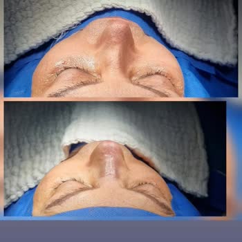 Acıbadem Hastanesinde Başarısız Burun Ameliyatı Ve 110 Bin TL İade Talebi