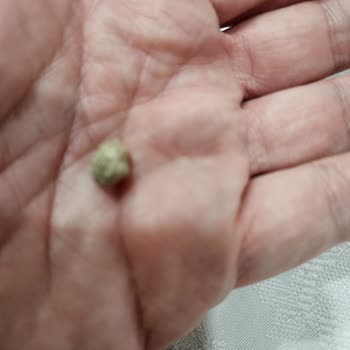 Yayla Nohut Ürünün İçinden Çıkan Taş Diş Hasarına Yol Açtı