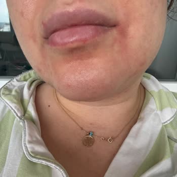 Madecassol Kremi Ciltte Şiddetli Yanma Ve Kuruluk Yarattı